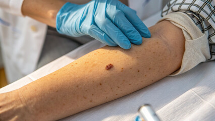 Close up view of concerned dermatologist examining mole on senior patient arm in clinic. Checking skin lesion for cancer