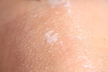 Fototapeta premium Closeup view of woman with dry skin