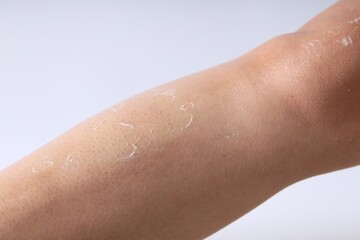 Woman with dry skin on her leg against light background, closeup