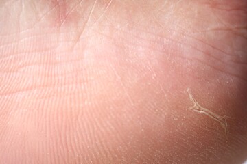Woman with dry skin on her foot, closeup