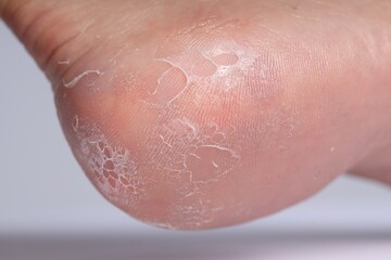Woman with dry skin on her foot against light background, closeup