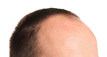 Obraz premium Baldness problem. Man with receding hairline on white background, closeup