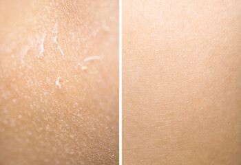 Dry skin on one side and moisturized on another, collage before and after