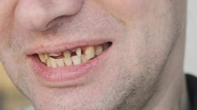 Man with bad diseased teeth affected by caries and periodontitis, smoker yellow teeth . Male touch his teeth prepared for dental crowns by the tongue. Dental problems and orthodontic treatment