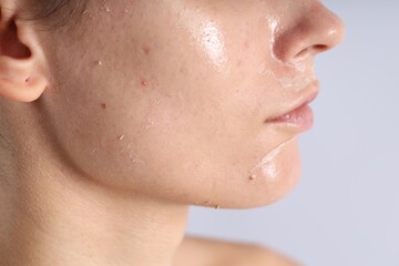 Woman with dry skin on her face against light background, closeup