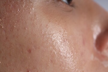 Woman with dry skin on her face, closeup