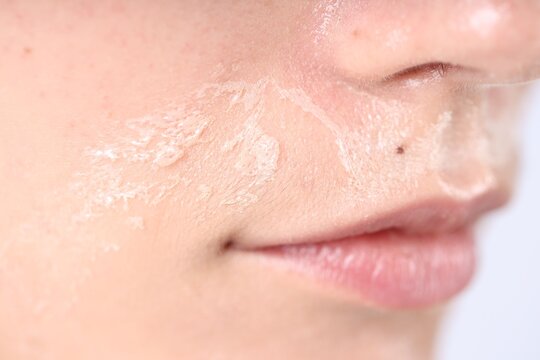 Fototapeta Woman with dry skin on her face against light background, closeup