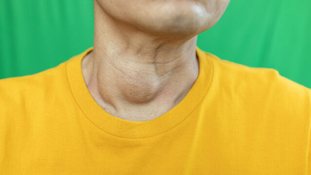 Thyroid gland inflammation at neck, goiter, throat cancer, sore throat and cough, man with neck pain on green, neck health problems concept