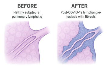 Medical illustration comparing a healthy subpleural pulmonary lymphatic vessel with one affected by post-COVID-19 lymphangiectasia and fibrosis.