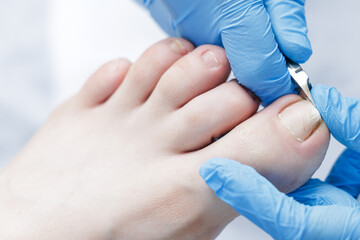 Podiatrist removes ingrown toenail on woman's foot, pedicure treatment
