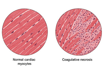 Microscopic comparison of normal cardiac myocytes and coagulative necrosis in heart muscle tissue.