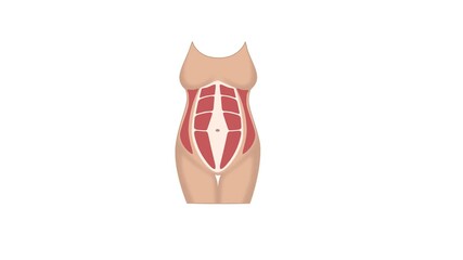 Diastasis Recti animation.A condition of a woman's abdominal muscles during pregnancy and postpartum.The sixpack of rectus abdominis muscles separates from the midline of the abdomen due to stretching