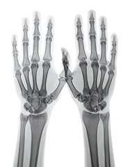 X-ray image of two hands, showing skeletal structure in grayscale. 