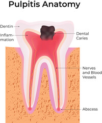 Pulpitis Anatomy Illustration Dental Caries Inflammation and Abscess Vector Illustration