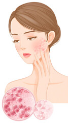 Illustration of a Woman with Rosacea Skin Condition, Showing Skin Inflammation and Enlarged View of Skin Cells, Representing Dermatological Issues and Skin Care