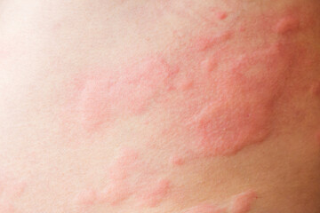 Fototapeta premium Skin allergy rash dermatitis texture close up background