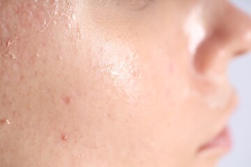 Woman with dry skin on her face, closeup