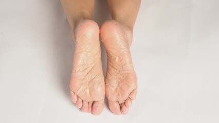 The soles of a pair of feet with peeling skin white backgrond.