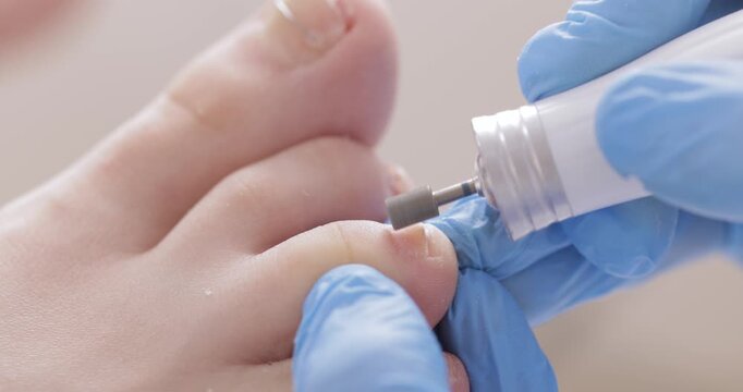 Professional podiatrist use podological brace titanium thread on toe nail with onychocryptosis or ingrown toenail, orthonyxia pedicure treatment on white background.