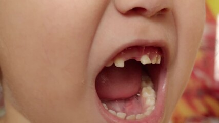 Child's hands pull out a wobbly milk tooth from the gumline