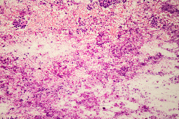 Medical themes: Microscopic image of lung cancer.