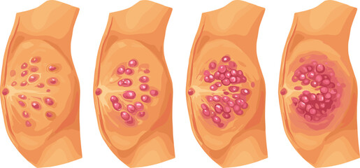 Breast cancer stages medical illustration, tumor growth vector diagram, human anatomy health awareness, oncology disease progression educational design for medicine and biology