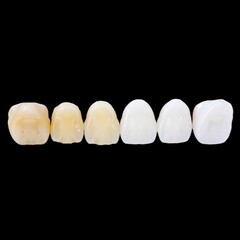 Six dental veneers in varying shades — from natural yellow to bright white — lined up against black, showcasing cosmetic tooth whitening options for a perfect smile.