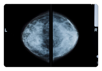 Mammogram both breast, cc view, breast scan. X-ray mammogram or mammography image for screening breast cancer. 