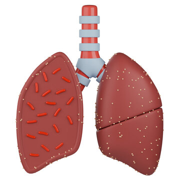 Lung with miliary tuberculosis 3d illustration. Tiny granulomas scattered across the lung tissue, with a rod-shaped Mycobacterium tuberculosis bacteria inside lung.