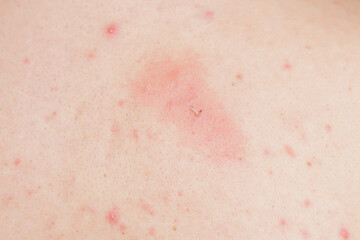 Fototapeta premium Squeezing blackheads on a man's back, focusing on detailed skin texture.