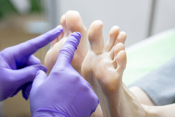 Podiatrist in Purple Gloves Examining a Patient's Feet and Toes. Foot Health Care