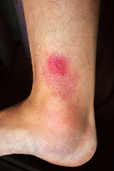 Fototapeta premium A red spot on a person's leg is the result of an insect bite. The affected area is inflamed and swollen