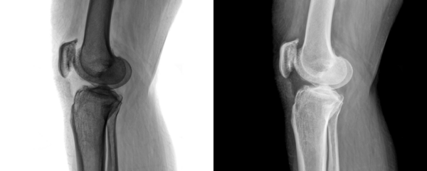 Diagnostic X-ray of Human Knee Joint in Lateral View Depicting Skeletal Structure for Arthritis Evaluation Isolated on Transparent Background for Clinical Research and Education