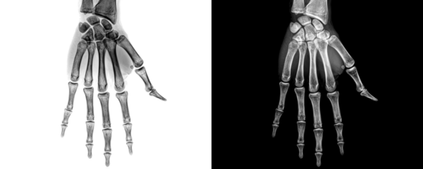High Resolution X-Ray of Hand in Anterior View Displaying Skeletal Framework for Fracture Assessment Isolated on Transparent Background