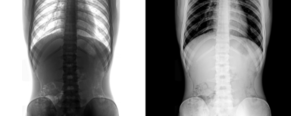 Abdomen Erect Prostate Anterior View X-Ray Radiograph Showing Abdominal Organs and Pelvic Structure for Pain Diagnosis Isolated on a Transparent Background