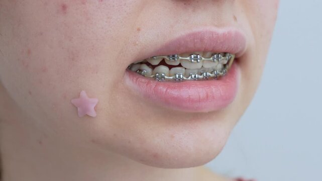 Braces with elastics in action as mouth opens wider, showcasing orthodontic adjustment and the gradual movement of teeth in a dynamic sequence