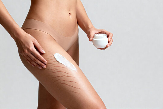 Young woman applying white cream on leg with stretch marks, highlighting body care and self-acceptance on plain background.