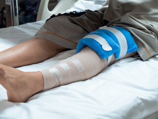 Close-up of injured leg with bandages and cold pack after ACL or meniscus knee surgery. Concept of post-operative recovery, pain relief, physical therapy, and orthopedic treatment in hospital care.