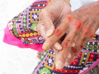 Gout arthritis disease sweling of old person, finger woman pain red finger illness, problem joint...