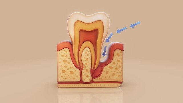 Conceptual 3D animation of human periodontitis