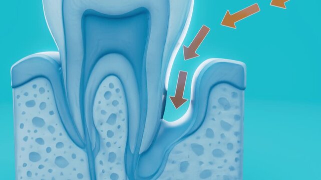 Conceptual 3D animation of human periodontitis