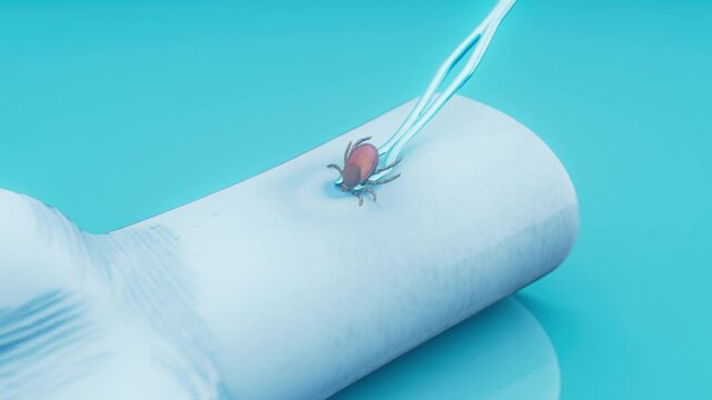 Conceptual 3D animation of the removal of a tick from human skin