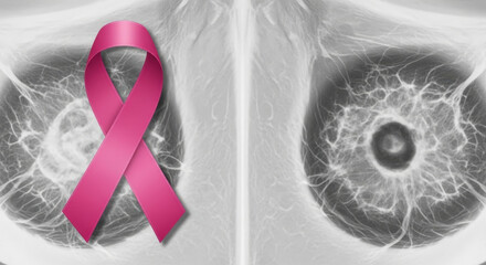 Understanding Mammography Screening for Early Detection of Breast Cancer