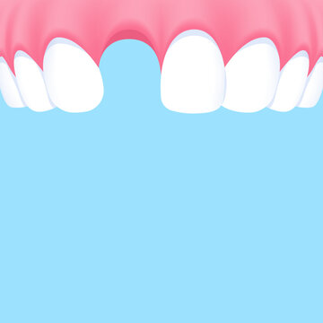 Upper teeth (Missing tooth) - Text box banner (square) illustration vector design. Dental care concept.