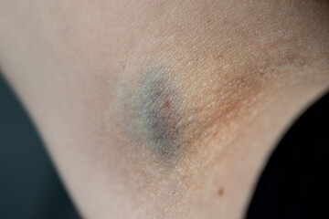 Fototapeta premium Bruise on arm after blood test, hematoma