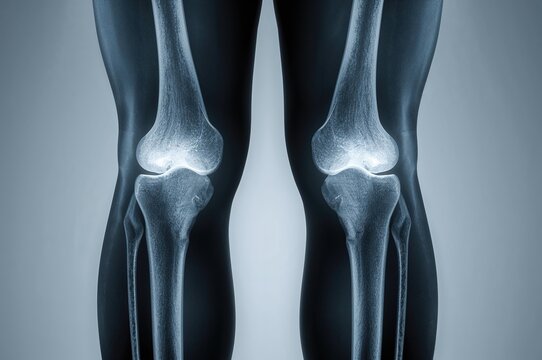 Central fracture observed in femur X-ray scans