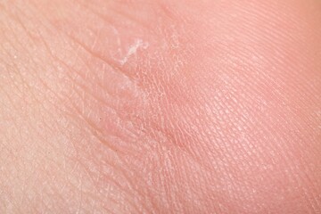 Macro view of dry human skin with wrinkles as background