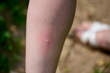 Red mark on leg highlights mosquito bite outdoors