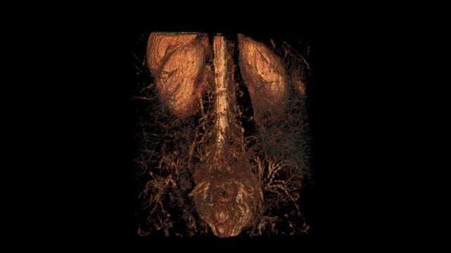 High-resolution STIR coronal VR movie of the lumbar spine, providing detailed visualization of vertebrae, intervertebral discs, and soft tissues. Ideal for radiologists, orthopedic specialists, 