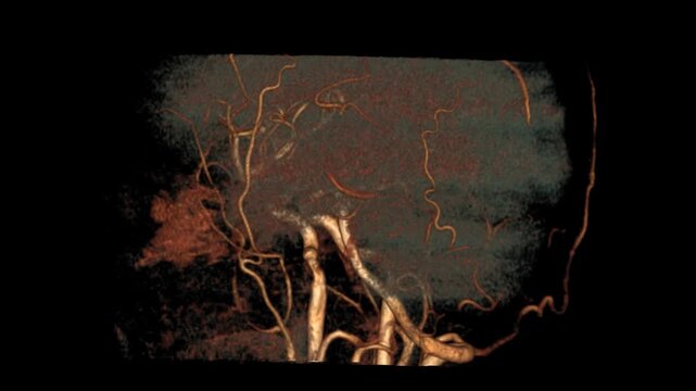 High-resolution MRA VR movie of the brain, showcasing detailed visualization of cerebral arteries and vascular structures. Perfect for neurologists, radiologists, and medical students studying 